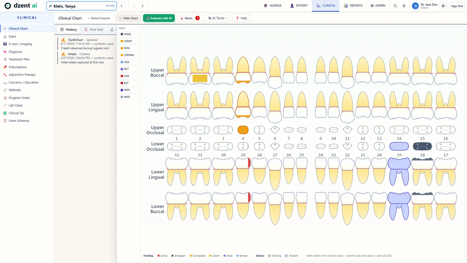 DzentAI clinical chart: anatomical 32-tooth odontogram with procedure palette, color-coded findings, and chart history